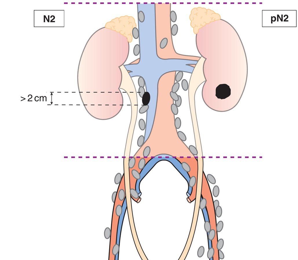 Schematic illustration of Metastasis in a single lymph node more than 2 cm or multiple lymph nodes.