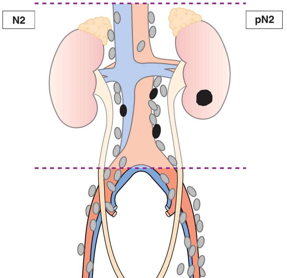 Schematic illustration of Metastasis in a single lymph node more than 2 cm or multiple lymph nodes.