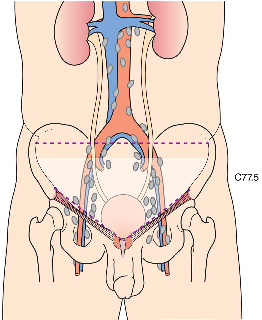 Schematic illustration of The regional lymph nodes are the nodes of the true pelvis, which essentially are the pelvic
nodes below the bifurcation and those along the common iliac arteries.