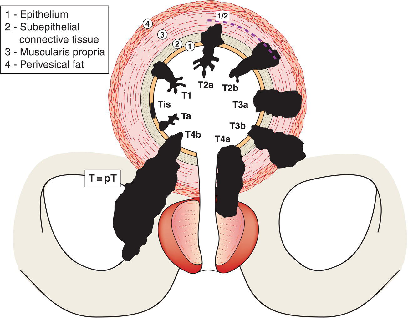 Schematic illustration of Primary Tumour.