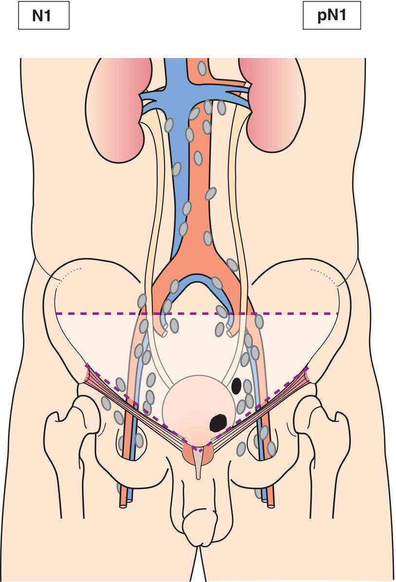 Schematic illustration of Metastasis in a single lymph node in the true pelvis.