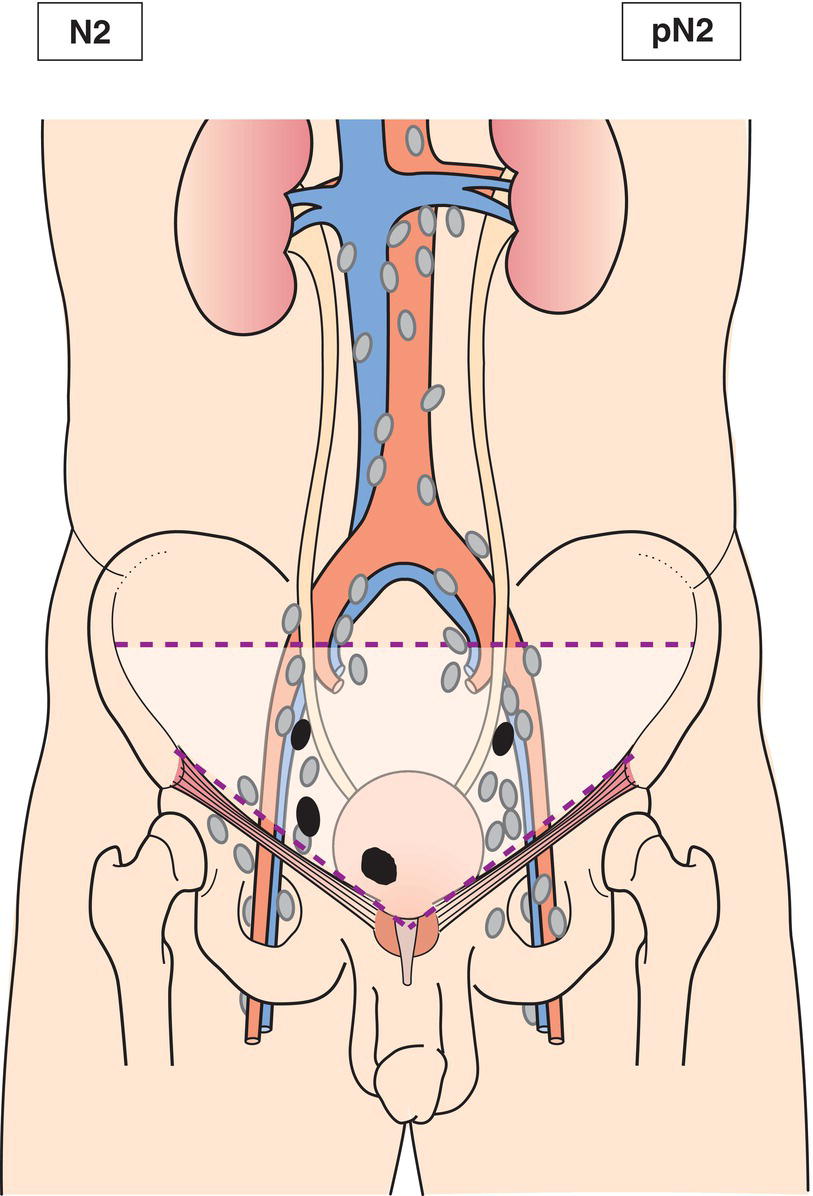 Schematic illustration of Metastasis in multiple regional lymph nodes in the true pelvis.