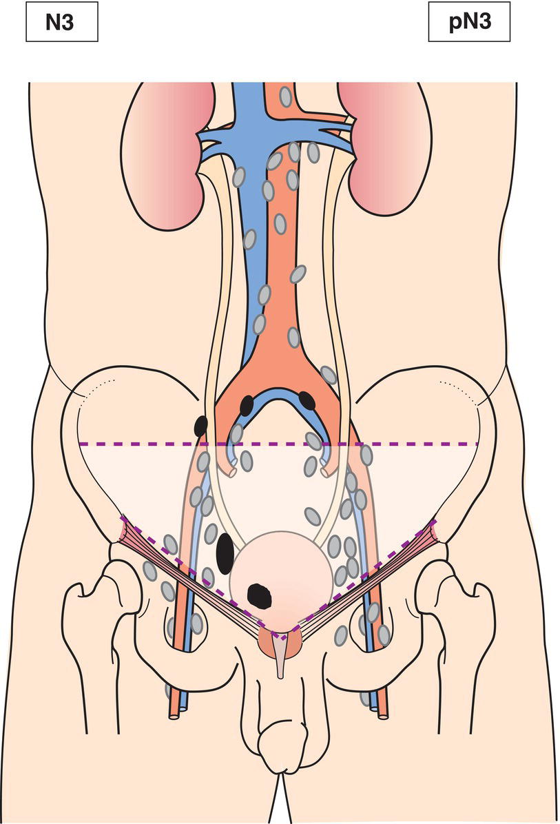 Schematic illustration of Metastasis in a common iliac lymph node(s).