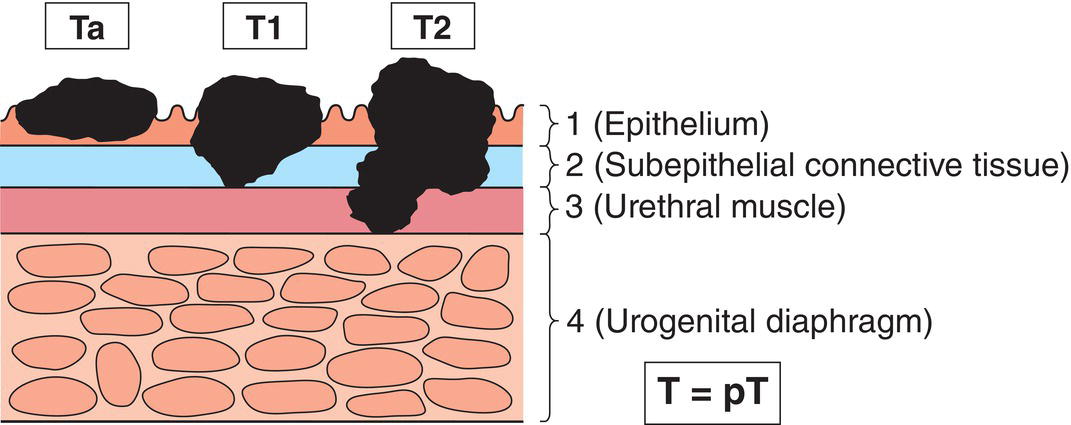 Schematic illustration of Noninvasive papillary, polypoid, or verrucous carcinoma.