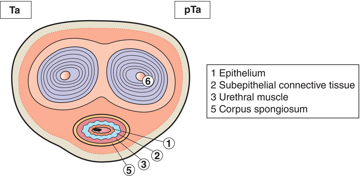 Schematic illustration of Noninvasive papillary, polypoid, or verrucous carcinoma.