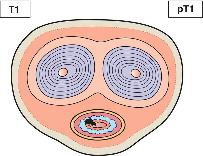 Schematic illustration of tumour invades subepithelial connective tissue.