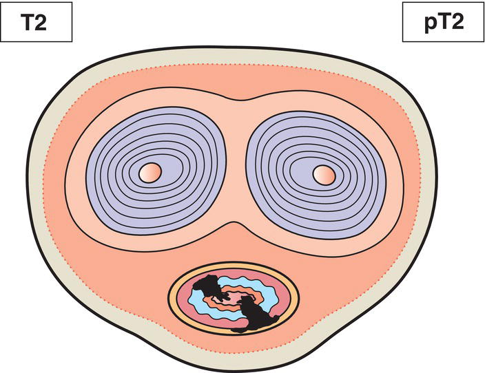 Schematic illustration of tumour invades any of the following: corpus spongiosum, prostate, periurethral muscle.