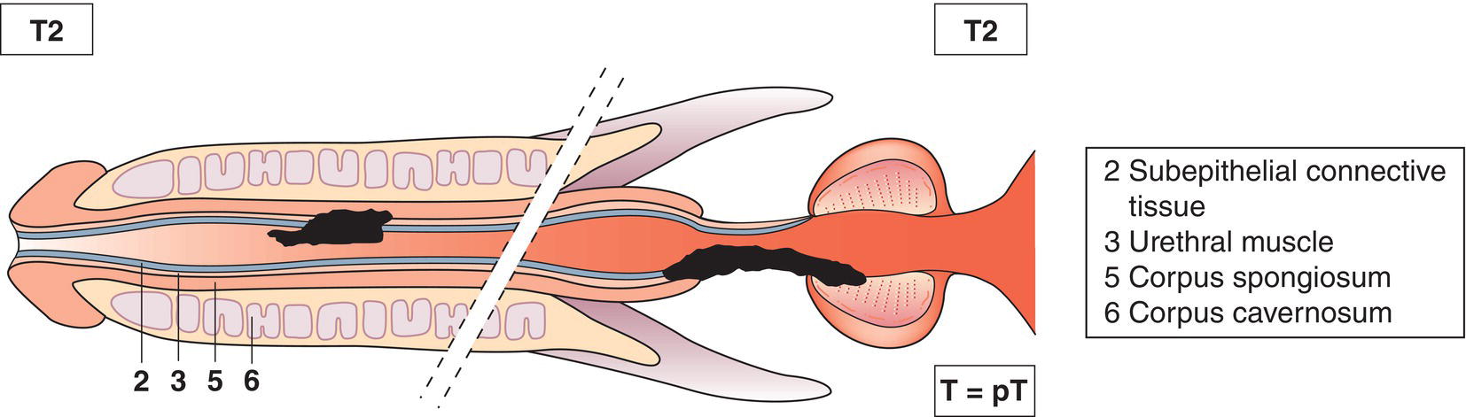 Schematic illustration of tumour invades any of the following: corpus spongiosum, prostate, periurethral muscle.