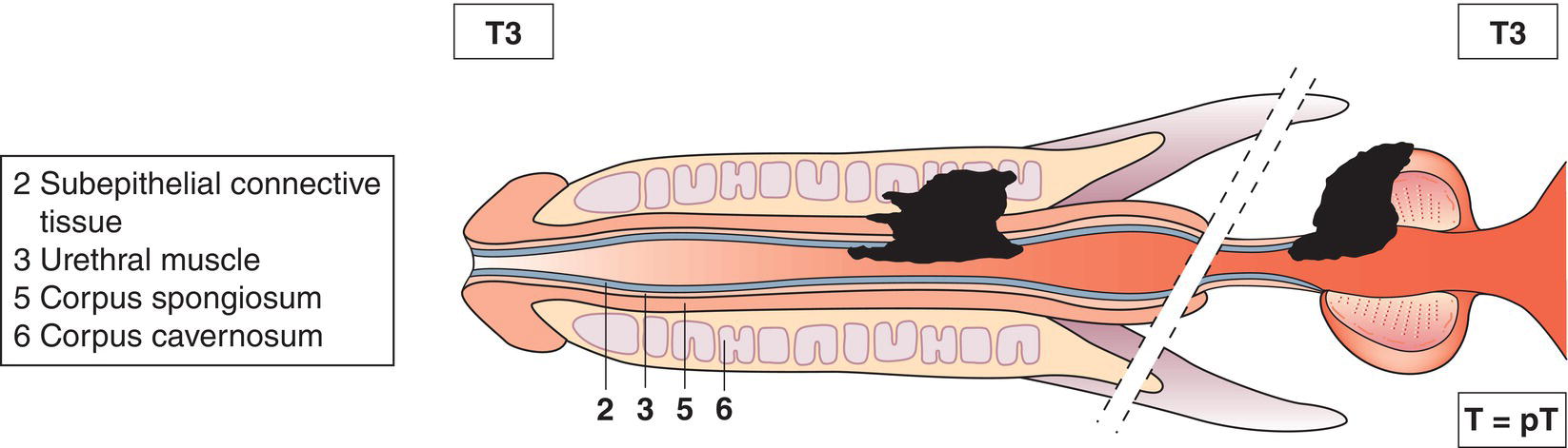 Schematic illustration of tumour invades any of the following: corpus cavernosum, beyond prostatic capsule, bladder neck.