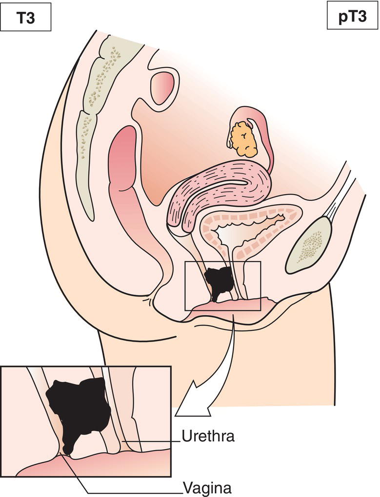 Schematic illustration of tumour invades any of the following: corpus cavernosum, beyond prostatic capsule, bladder neck.