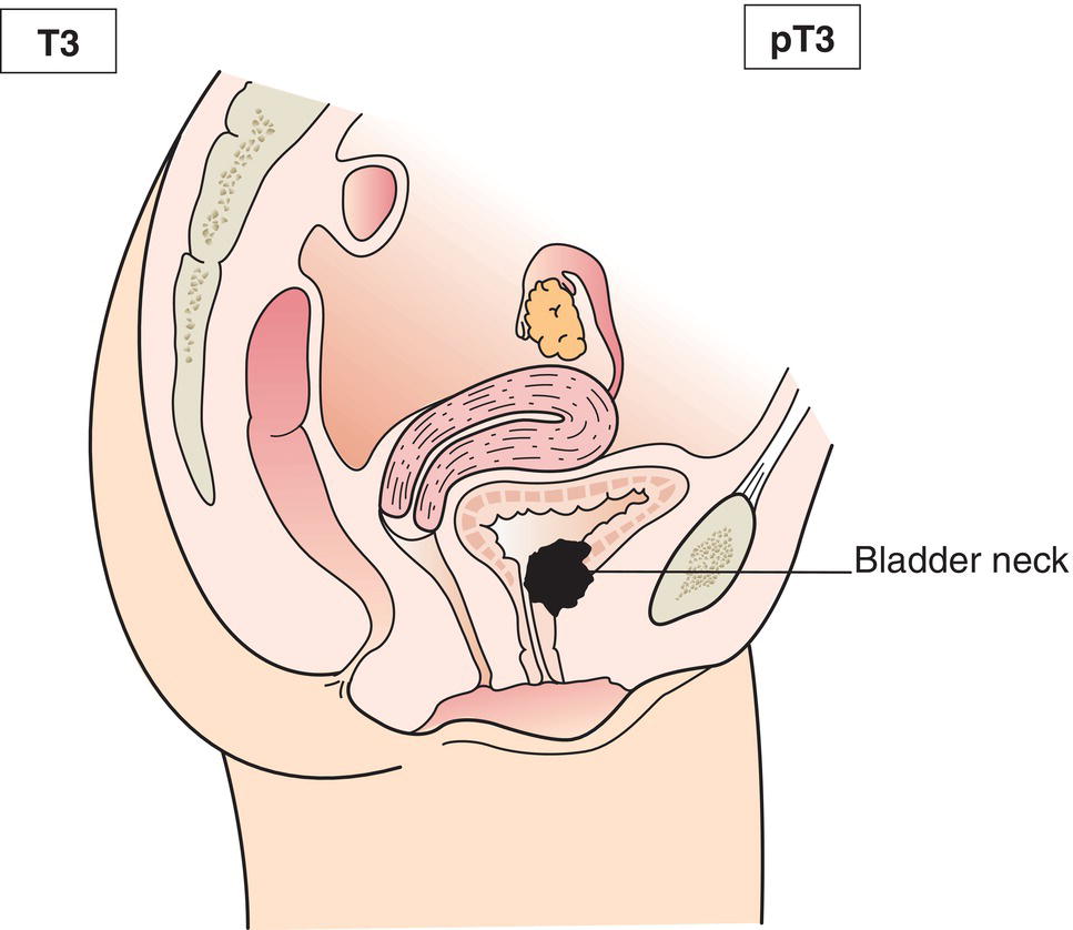 Schematic illustration of tumour invades any of the following: corpus cavernosum, beyond prostatic capsule, bladder neck.