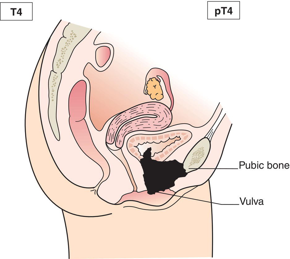 Schematic illustration of tumour invades other adjacent organs.