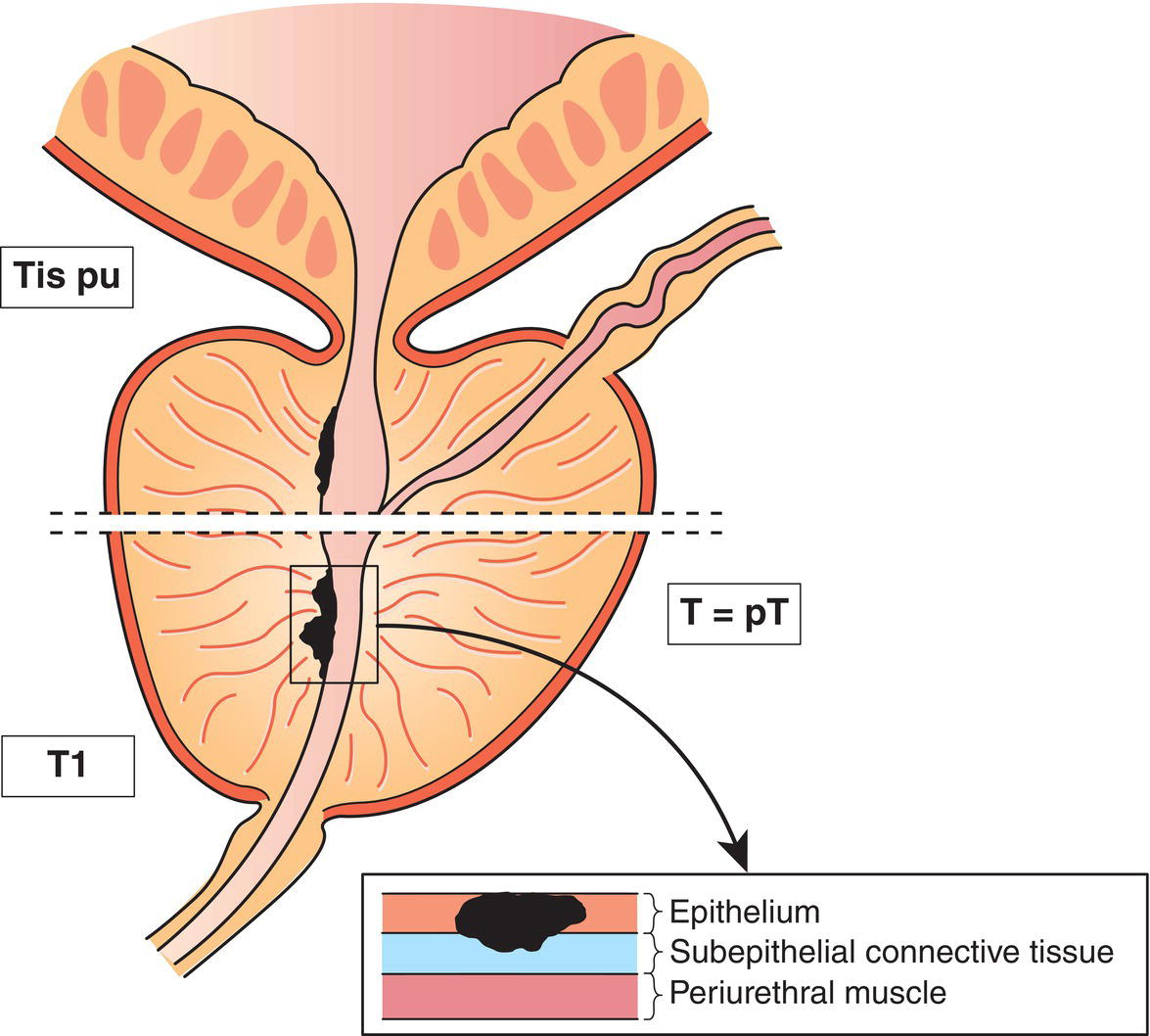 Schematic illustration of Carcinoma in situ, involving prostatic urethra, periurethral or prostatic ducts without stromal invasion.