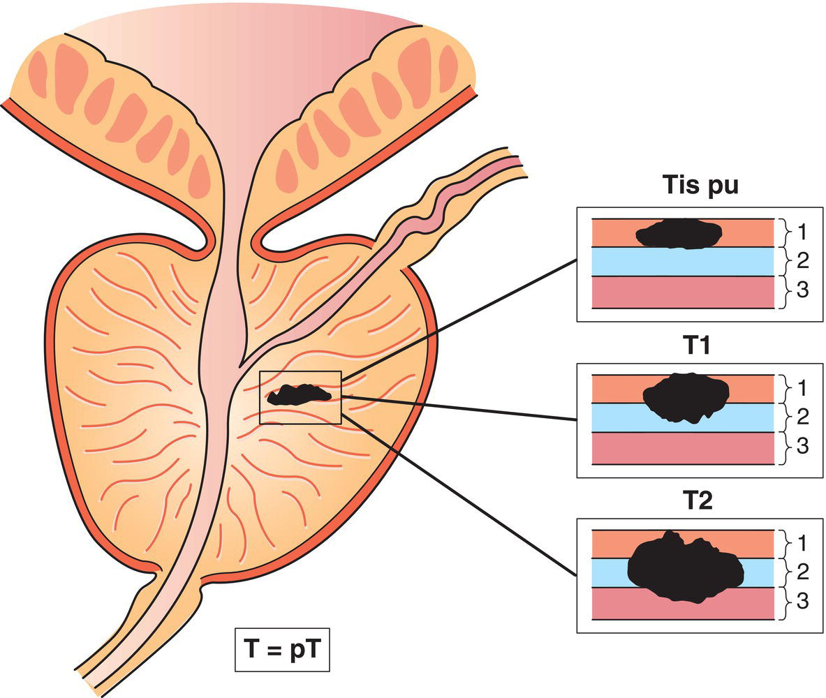 Schematic illustration of Carcinoma in situ, involving prostatic urethra, periurethral or prostatic ducts without stromal invasion.