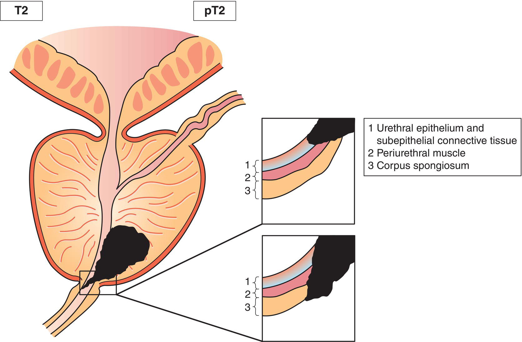 Schematic illustration of tumour invades subepithelial connective tissue.