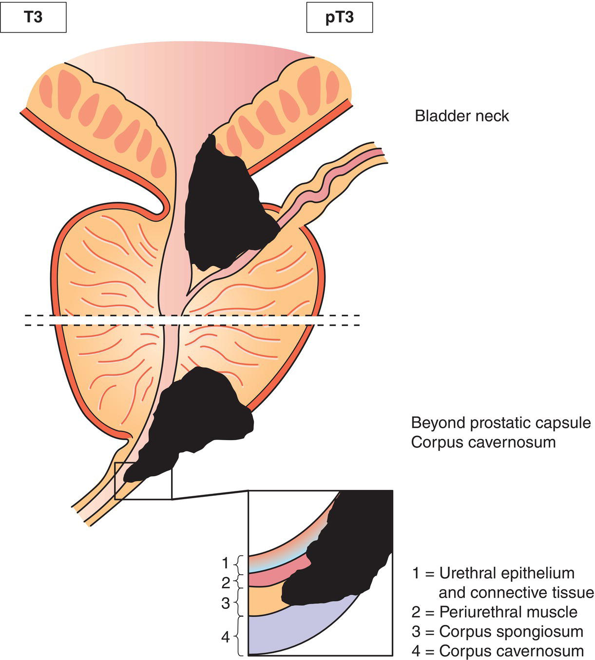 Schematic illustration of tumour invades any of the following: corpus cavernosum, beyond prostatic capsule, bladder neck.