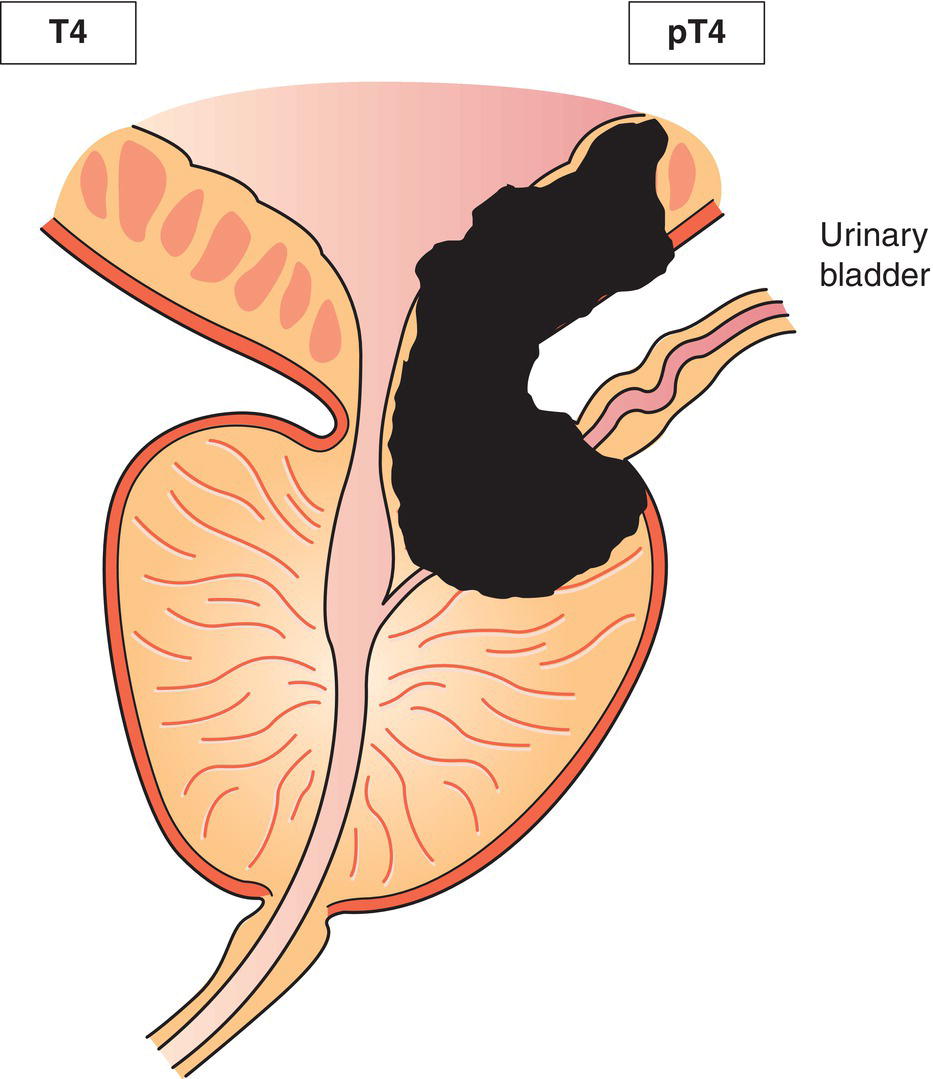 Schematic illustration of tumour invades other adjacent organs.