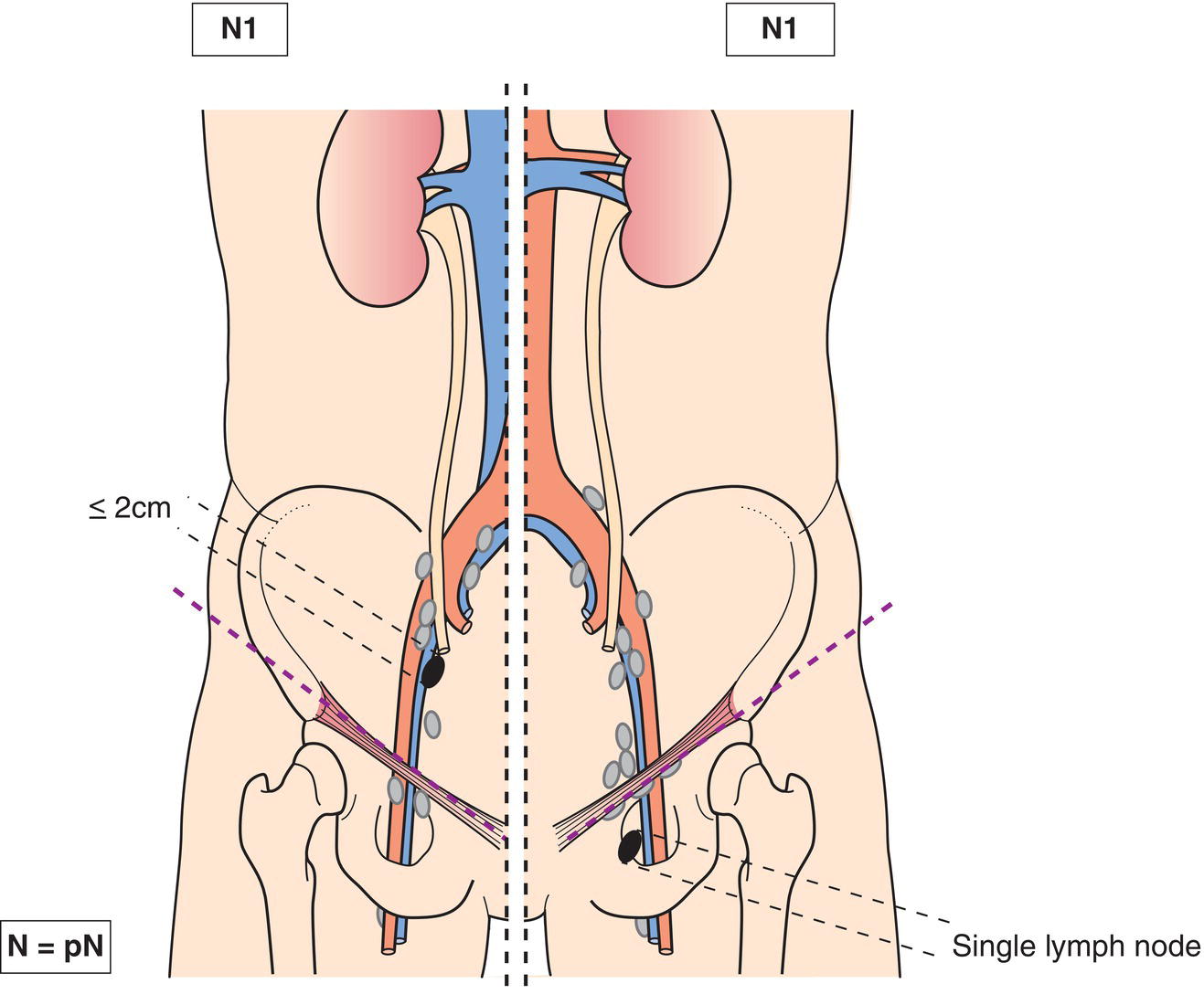 Schematic illustration of Metastasis in a single lymph node.