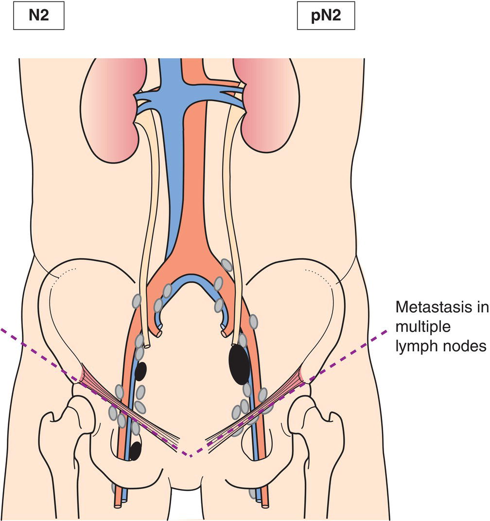 Schematic illustration of Metastasis in multiple lymph nodes.