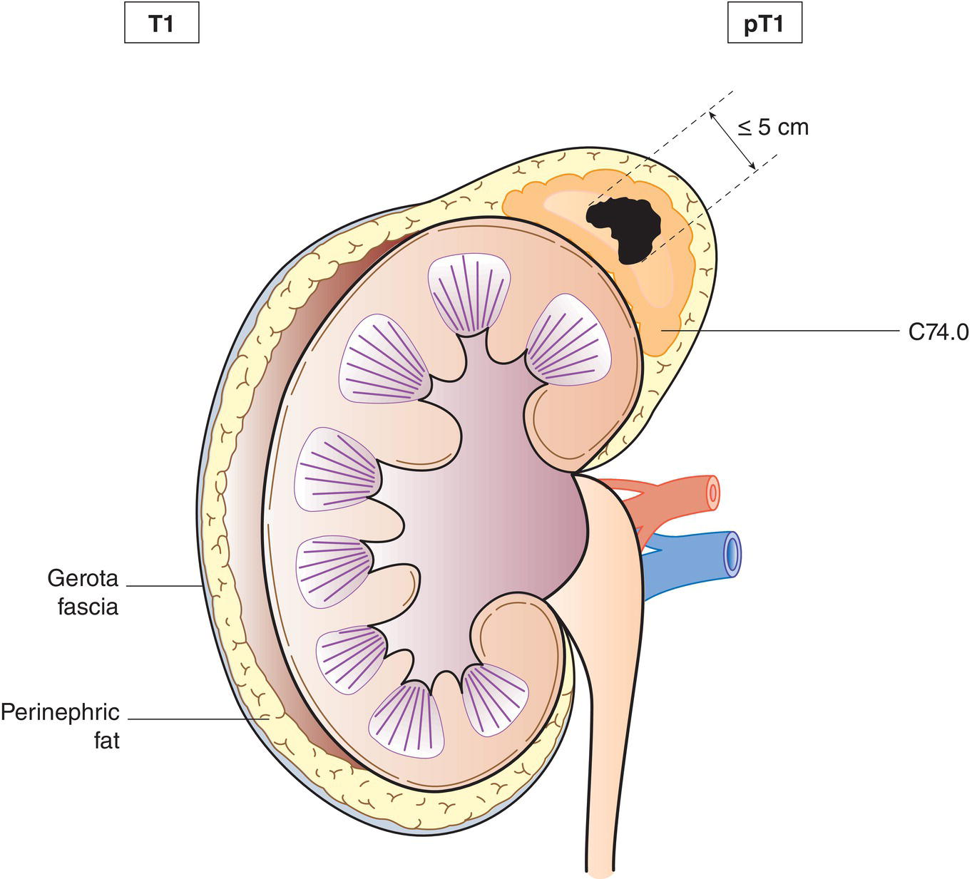 Schematic illustration of tumour 5 cm or less in greatest dimension, no extra-adrenal invasion.