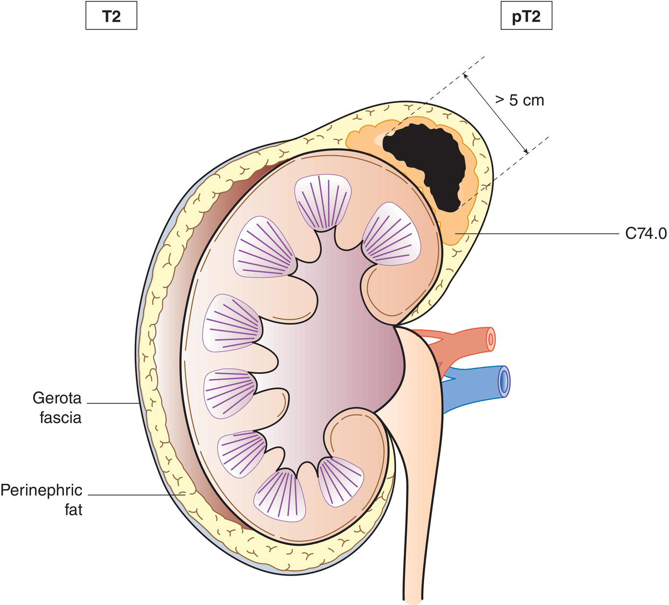 Schematic illustration of tumour greater than 5 cm, no extra-adrenal invasion.