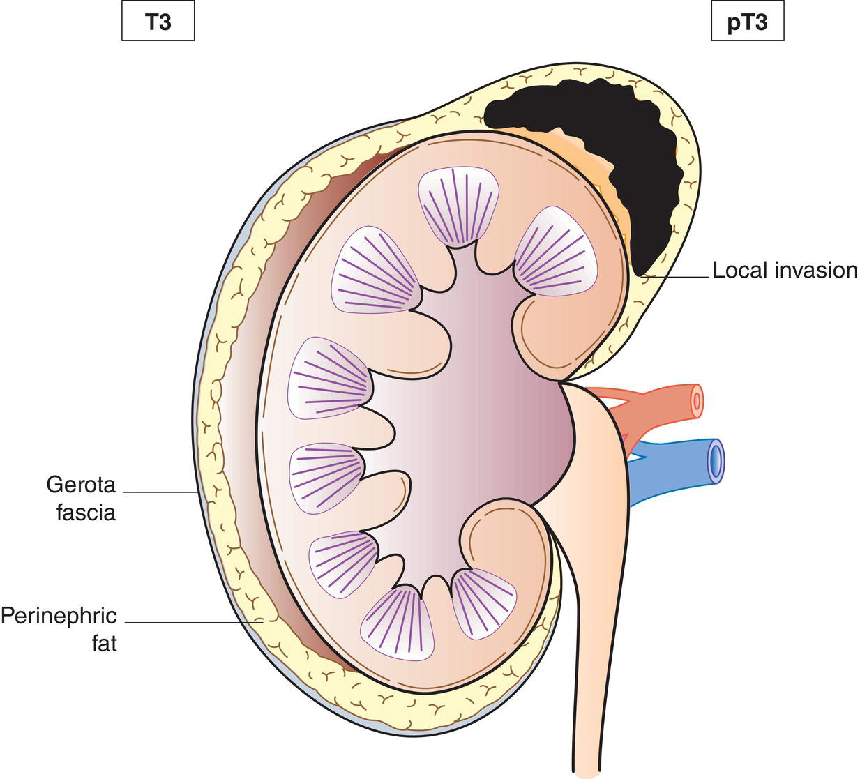 Schematic illustration of tumour of any size with local invasion, but not invading adjacent organs.