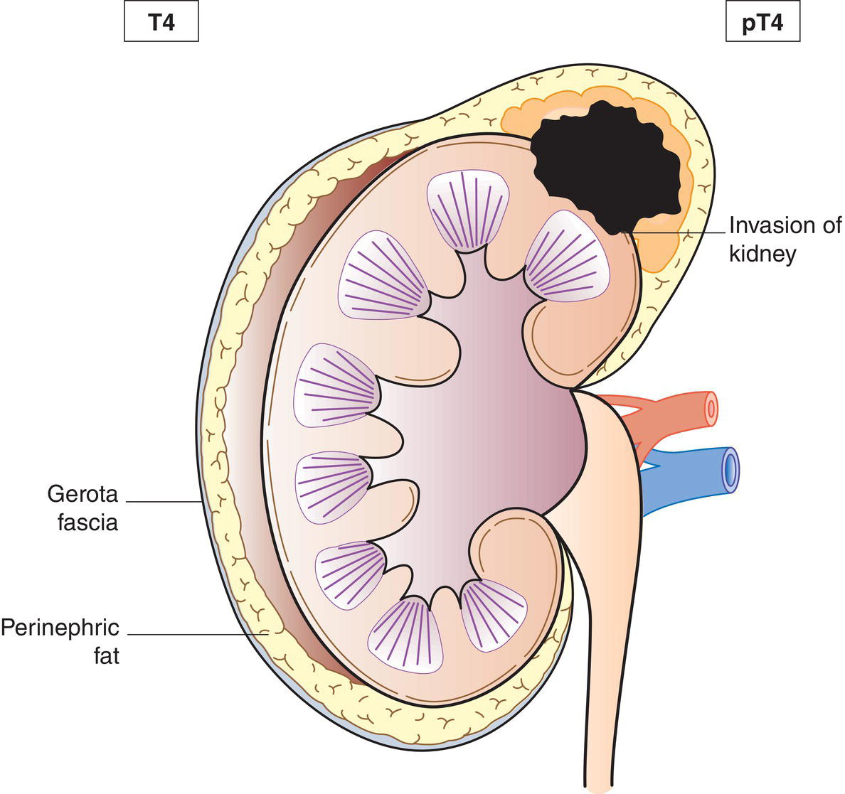 Schematic illustration of tumour of any size with invasion of adjacent organs.