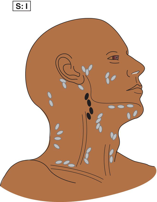 Schematic illustration of Involvement of a single lymph node region.