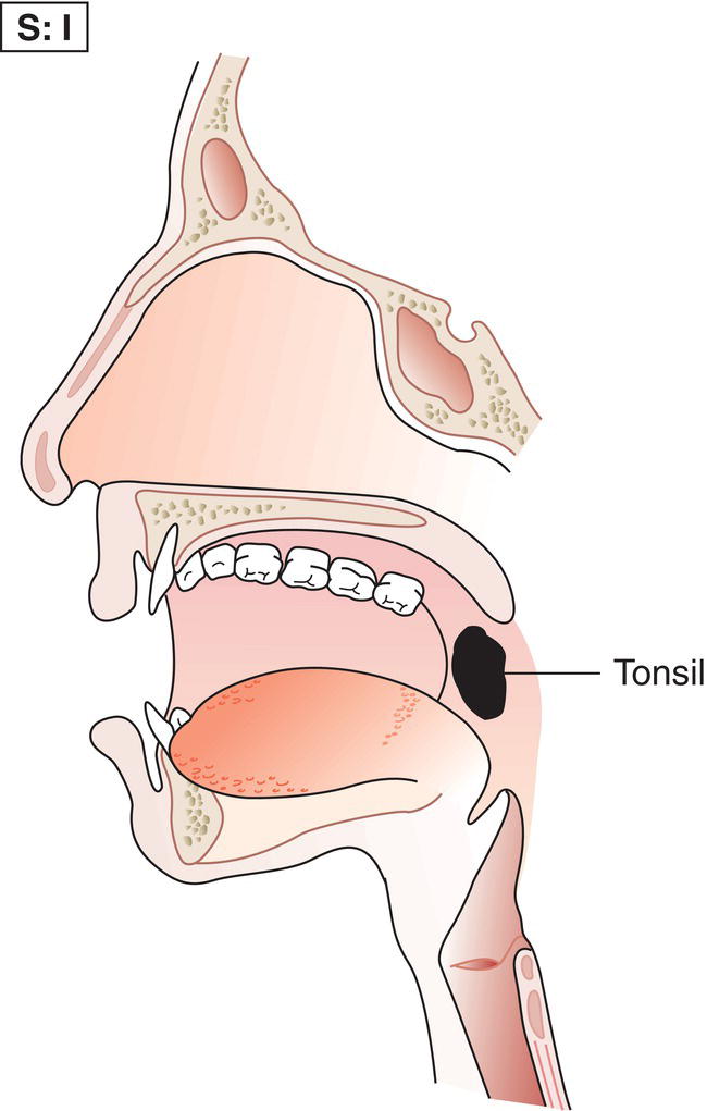 Schematic illustration of Involvement of a single lymph node region tonsil.