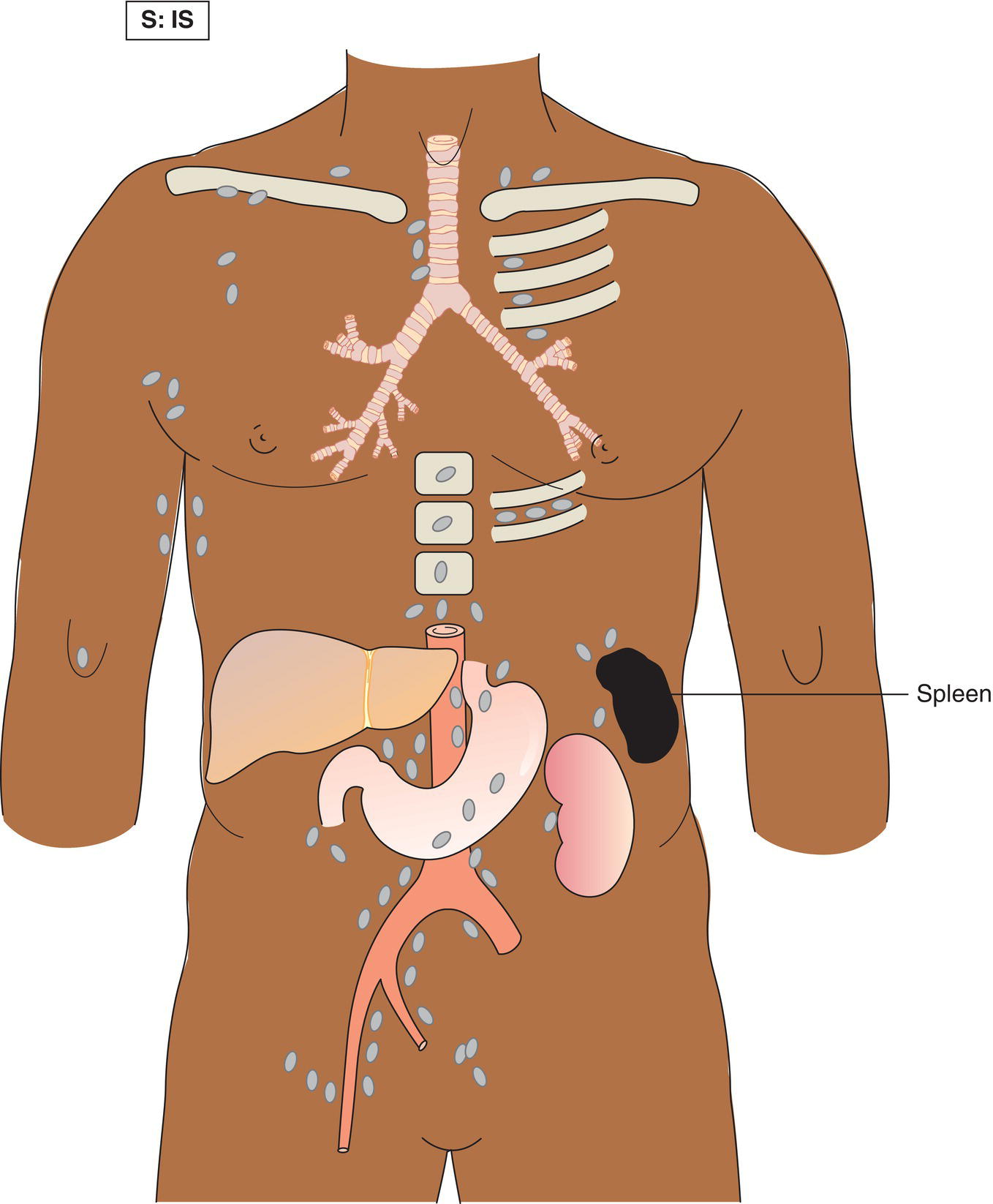 Schematic illustration of Involvement of a single lymph node region spleen.