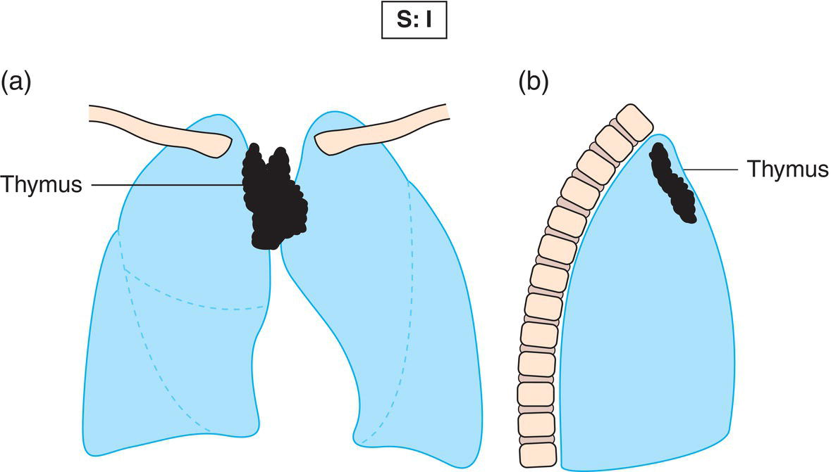 Schematic illustration of Involvement of a single lymph node region thymus.