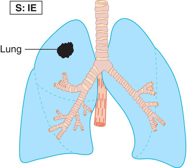 Schematic illustration of localized involvement of a single extralymphatic organ Lung.