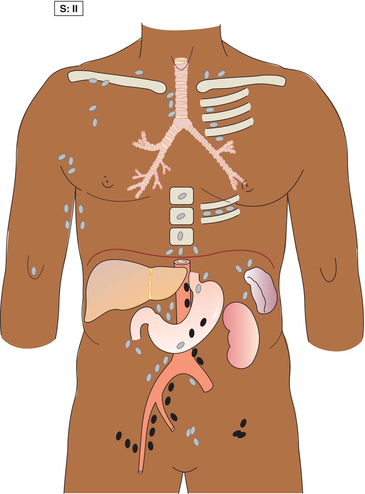 Schematic illustration of Involvement of two or more lymph node regions on the same side of the diaphragm.