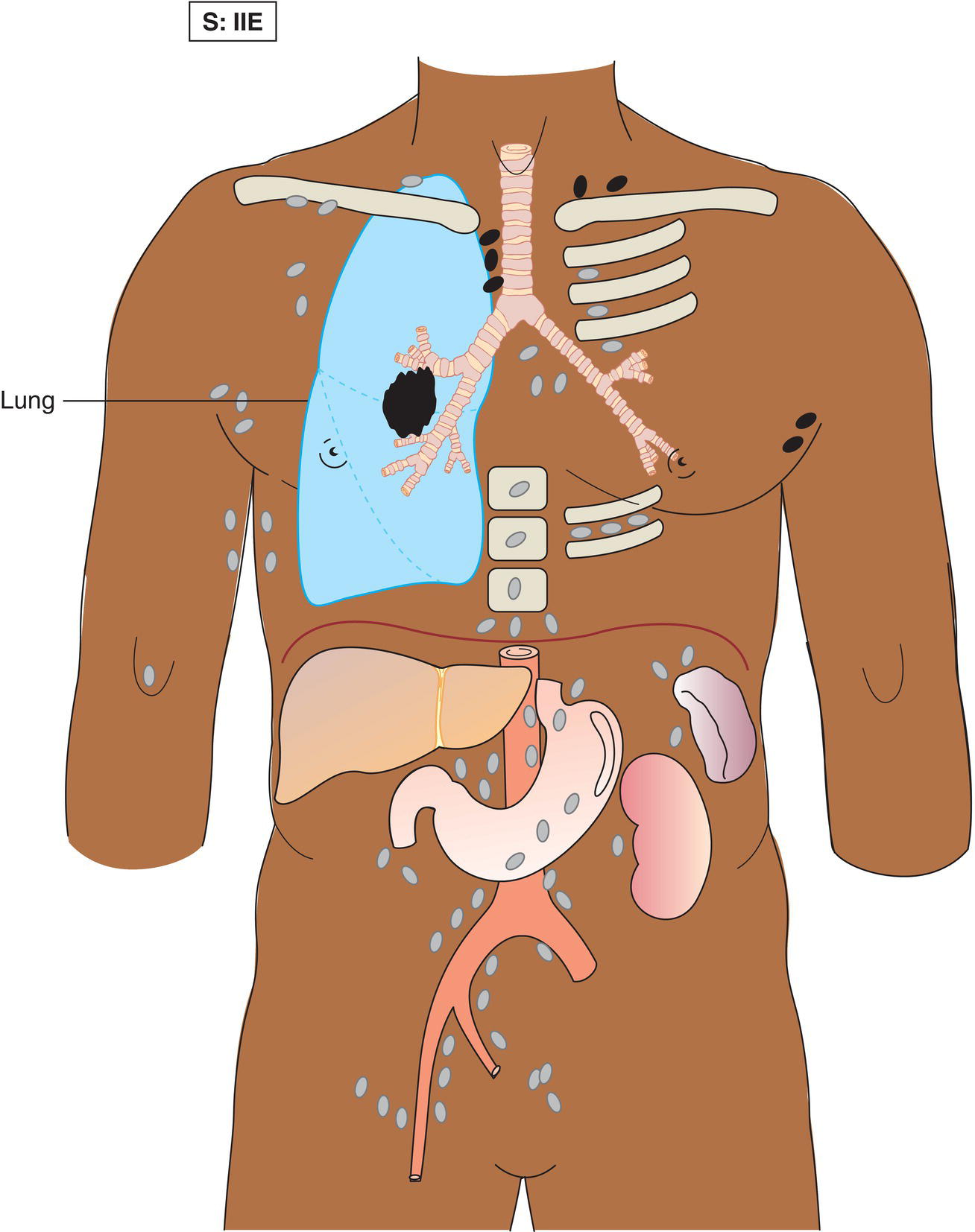 Schematic illustration of localized involvement of a single extralymphatic organ or site and its regional lymph node(s) with or without involvement of other lymph node regions on the same side of the diaphragm.