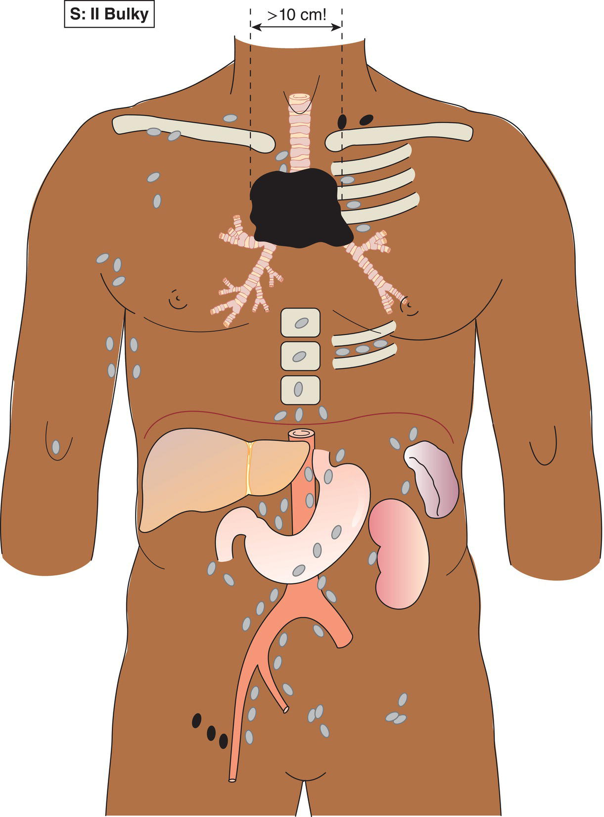 Schematic illustration of Stage II disease with a single nodal mass greater than 10 cm in maximum dimension or greater than a third of the thoracic diameter as assessed on CT.