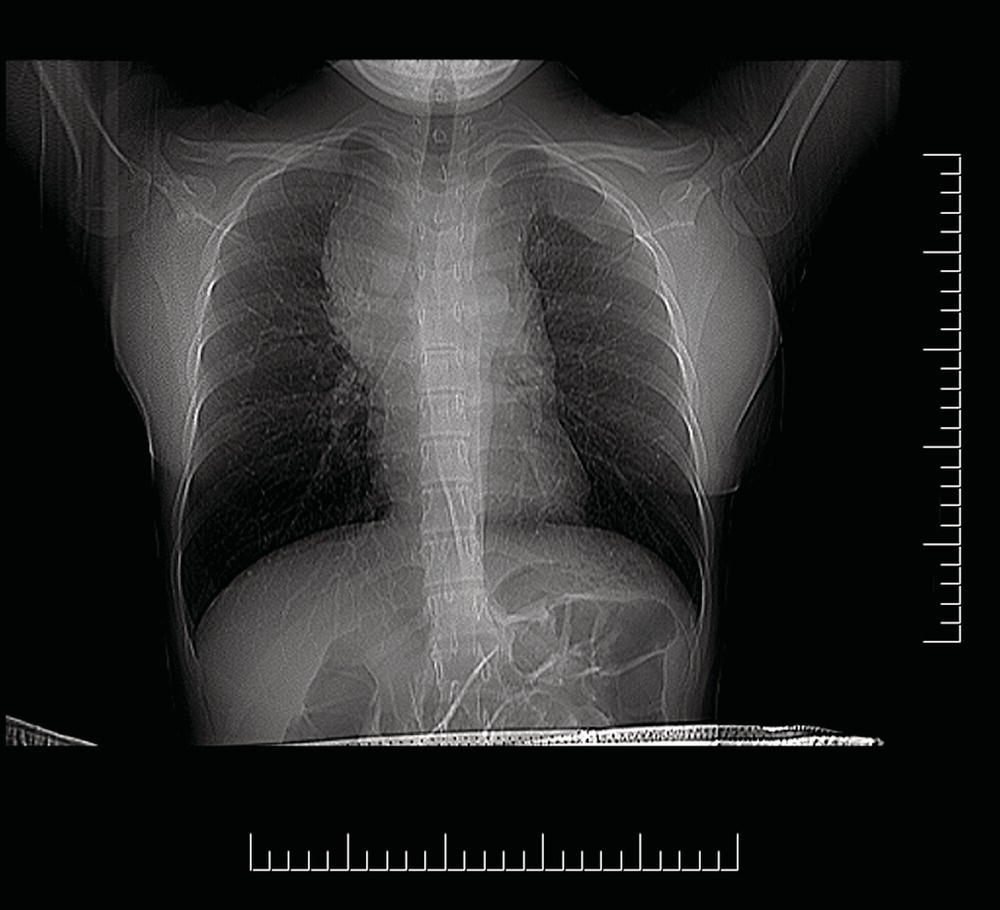 Photo depicts Stage II disease with a single nodal mass greater than 10 cm in maximum dimension or greater than a third of the thoracic diameter as assessed on CT.