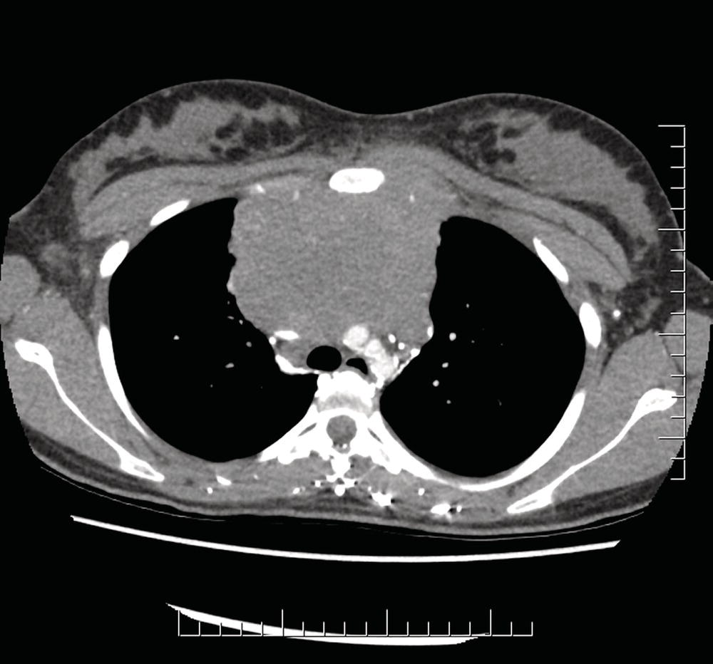 Photo depicts Stage II disease with a single nodal mass greater than 10 cm in maximum dimension or greater than a third of the thoracic diameter as assessed on CT.