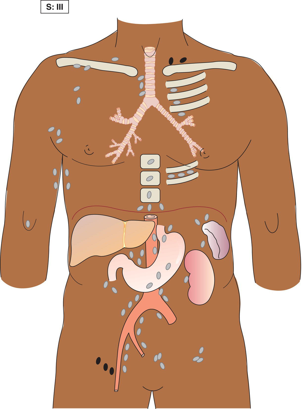 Schematic illustration of Involvement of lymph node regions on both sides of the diaphragm (III).