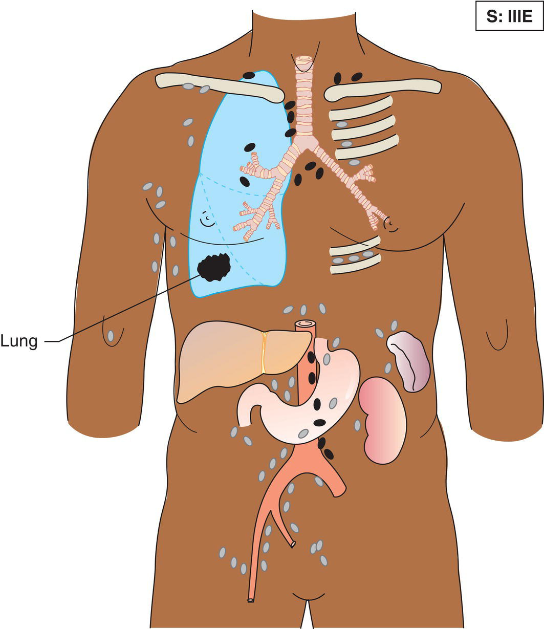 Schematic illustration of Involvement of lymph node regions on both sides of the diaphragm (III), which may also be accompanied by localized involvement of an associated extralymphatic organ or site.