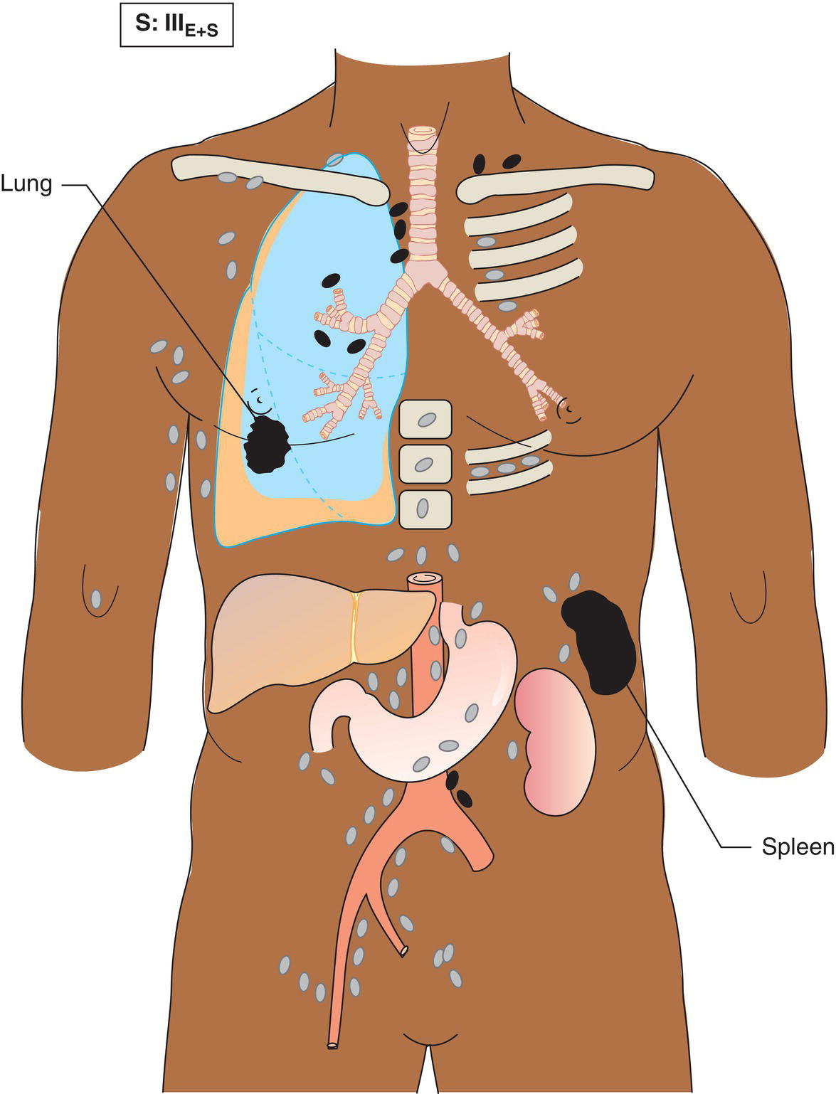 Schematic illustration of Involvement of lymph node regions on both sides of the diaphragm (III), which may also be accompanied by involvement of the spleen (IlIS), or both (IIIE + S).