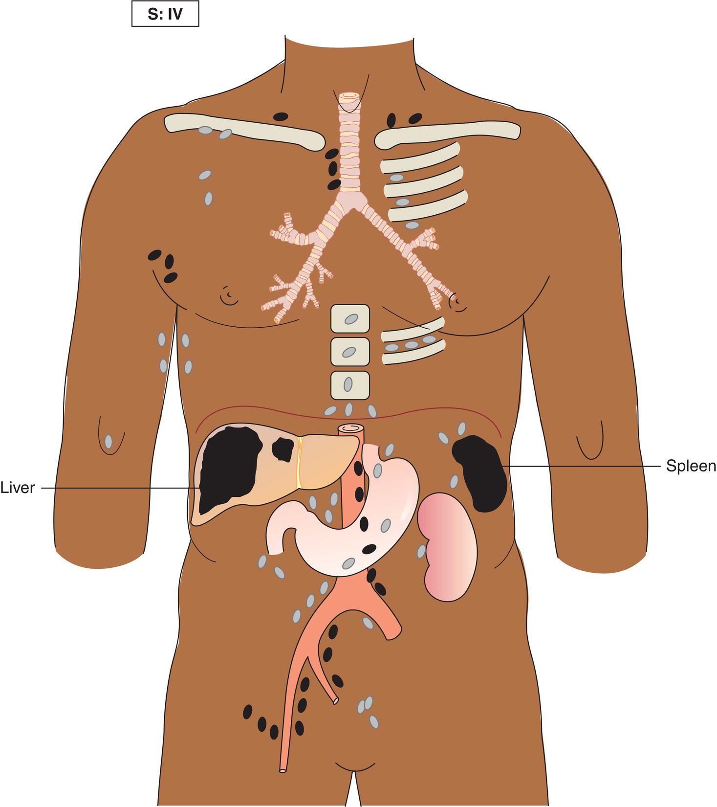 Schematic illustration of Disseminated (multifocal) involvement of one or more extralymphatic organs, with or without associated lymph node involvement.