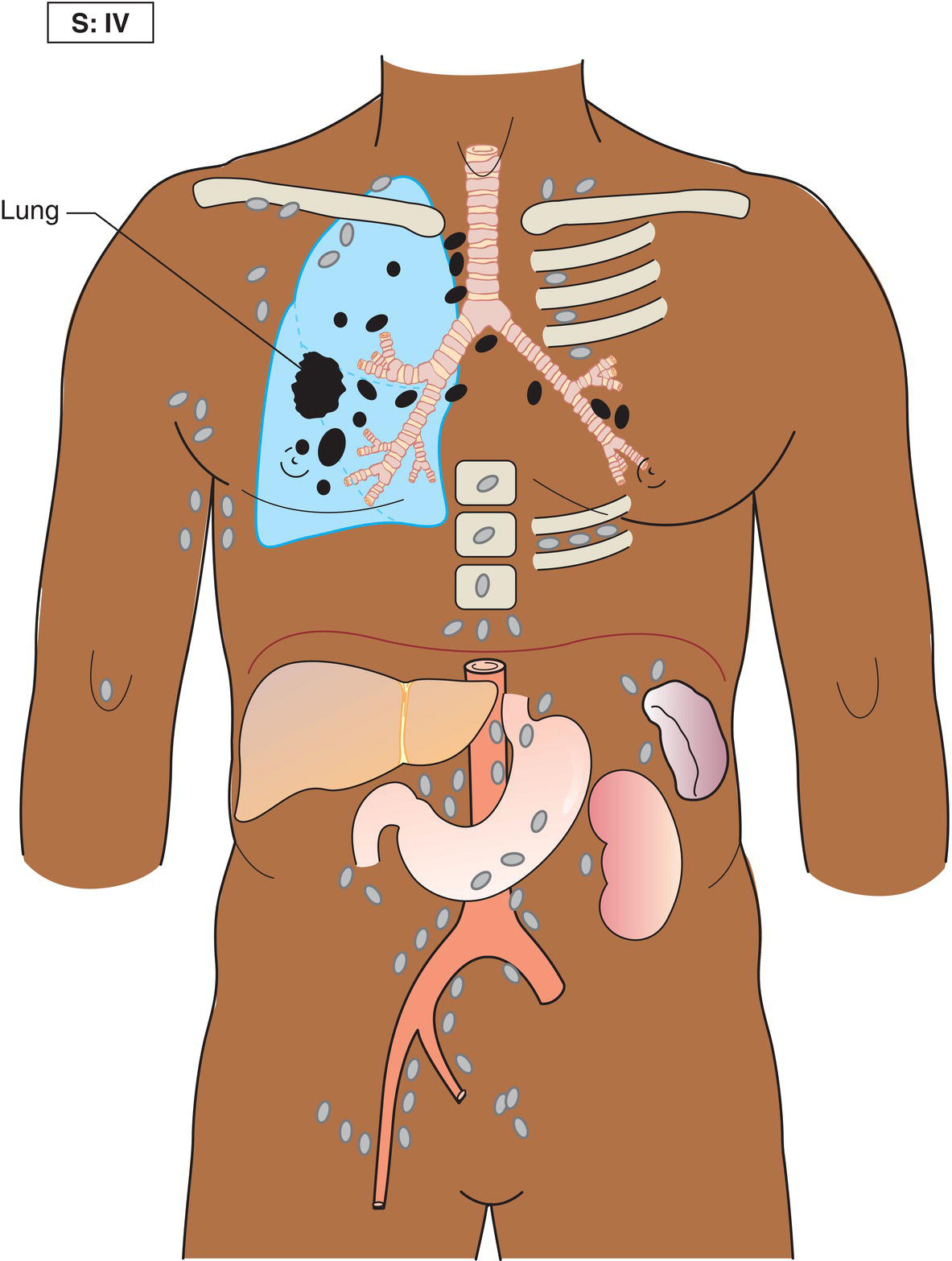 Schematic illustration of Disseminated (multifocal) involvement of one or more extralymphatic organs, with or without associated lymph node involvement.