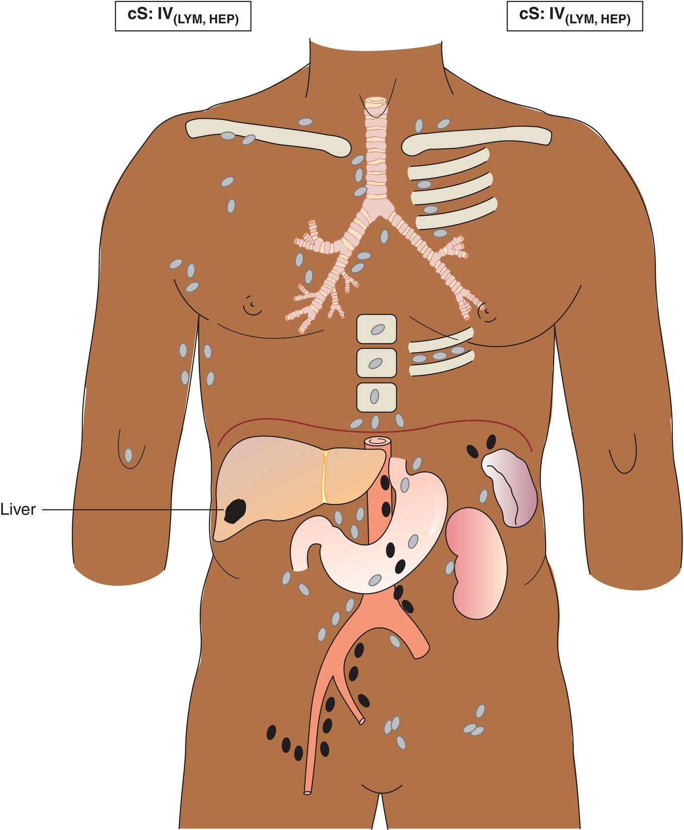 Schematic illustration of Disseminated (multifocal) involvement of one or more extralymphatic organs, with or without associated non‐contiguous extralymphatic organ involvement with involvement of lymph node regions on the same or both sides of the diaphragm.