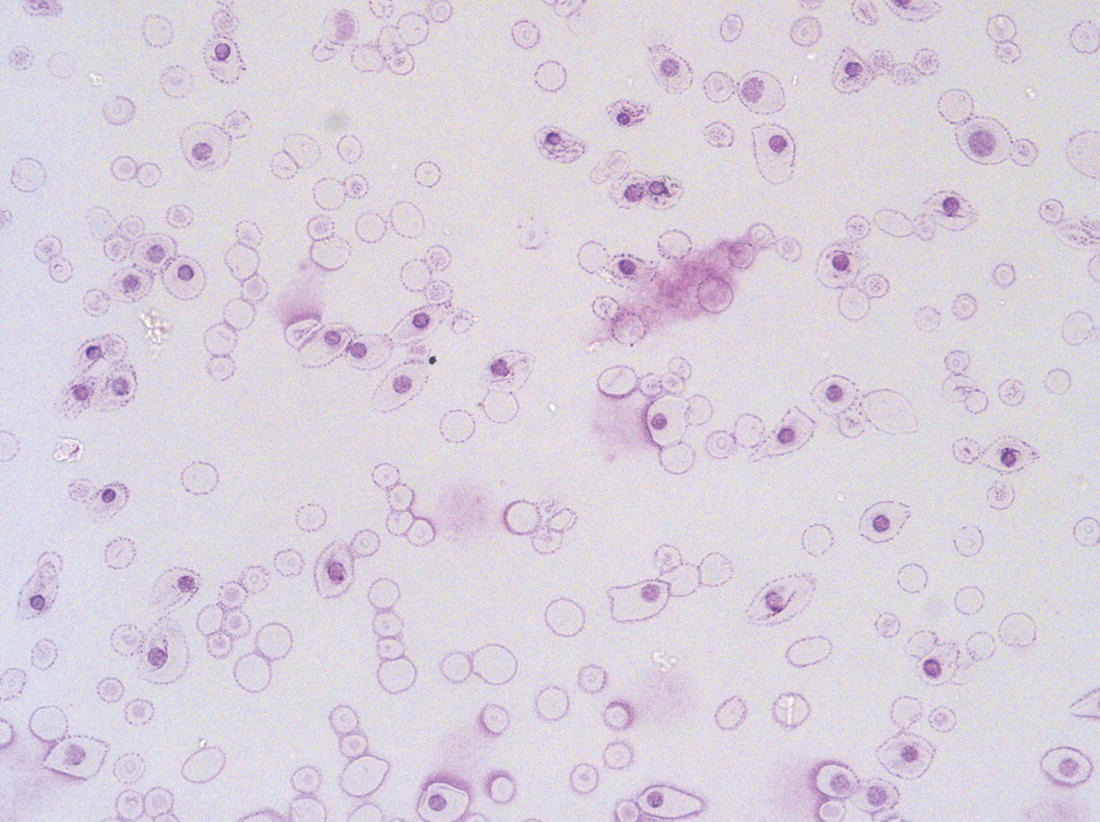 Photo depicts first trimester (8 weeks) fetal blood film showing the large size of the erythroblasts typical of those derived from the yolk sac.