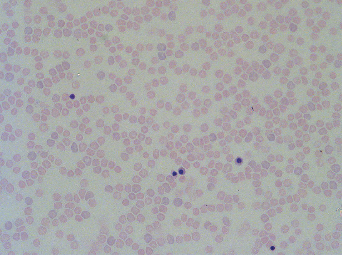 Photo depicts second trimester (14 weeks) fetal blood film showing typical erythroblasts derived from definitive haematopoiesis.