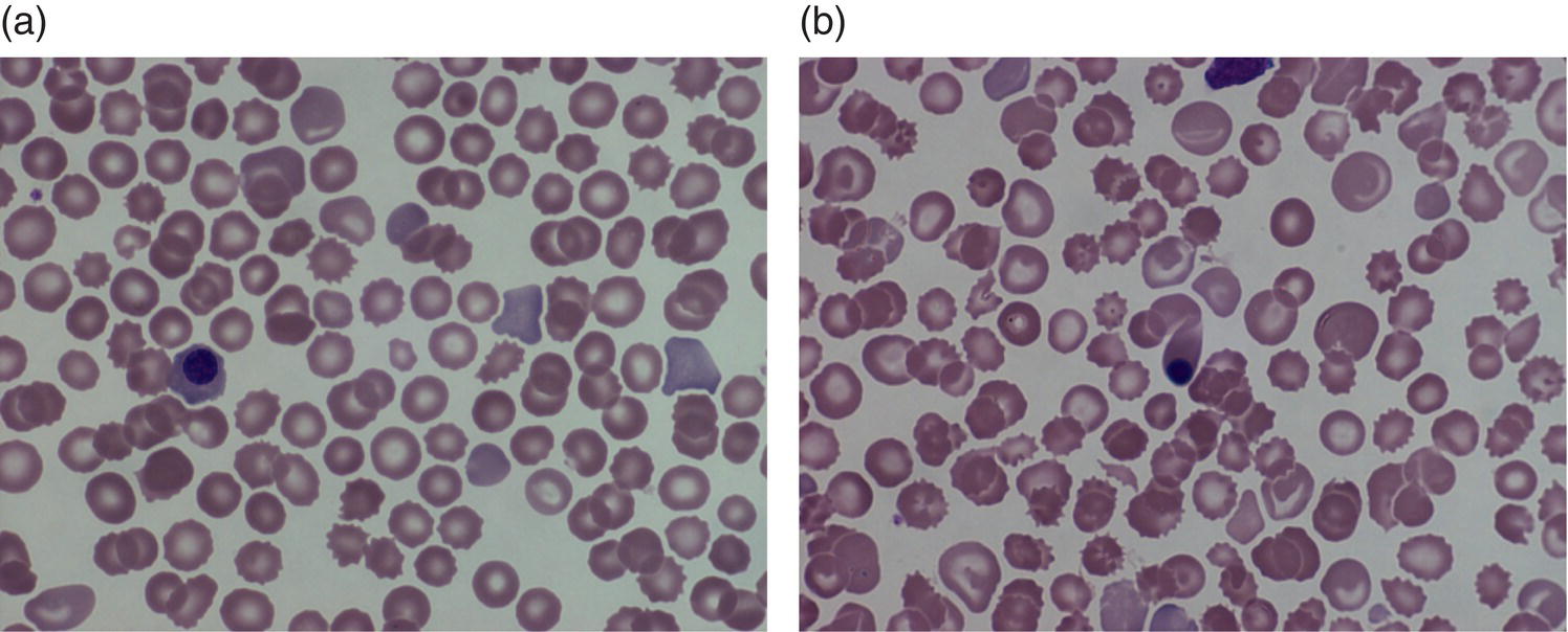 Photo depicts normal preterm red cells at different gestational ages.