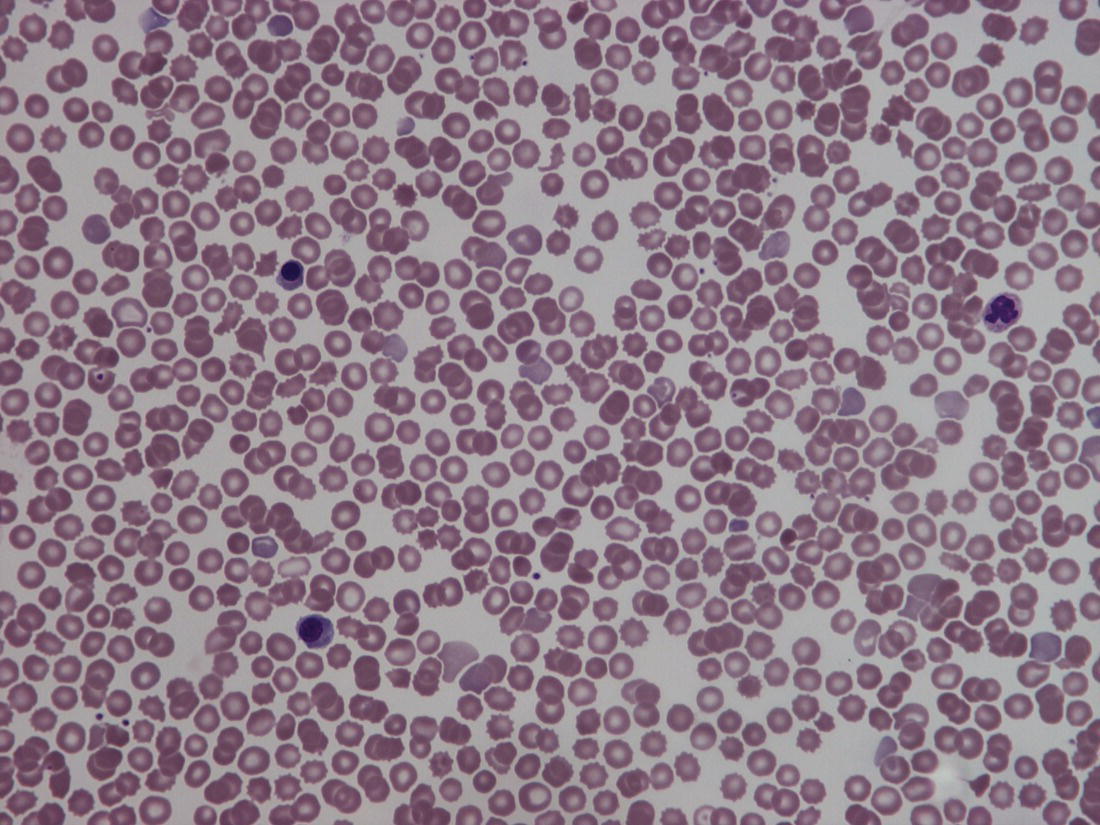 Photo depicts a blood film of a normal preterm baby (born at 28 weeks’ gestation) showing a degree of erythroblastosis.