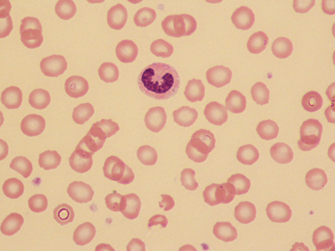 Photo depicts a blood film of a term neonate with anaemia due to parvovirus B19 infection showing normochromic normocytic red cells with occasional schistocytes and an absence of polychromasia.