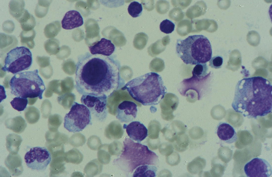 Photo depicts bone marrow film of a neonate with Pearson syndrome showing vacuolation of erythroid and myeloid cells and a dysplastic megakaryocyte.