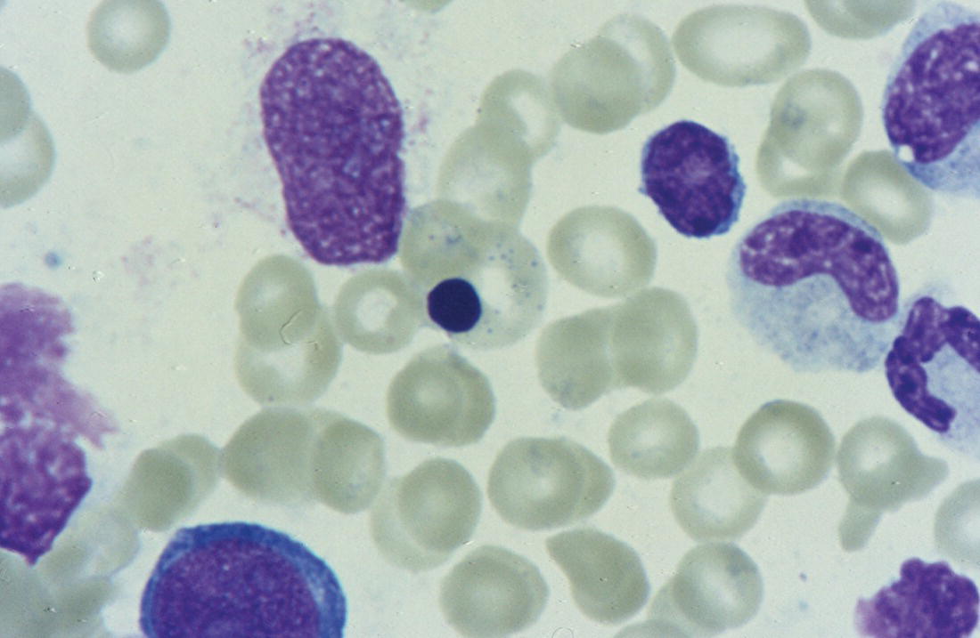 Photo depicts basophilic stippling in a bone marrow erythroblast (centre field) from a neonate with Pearson syndrome.